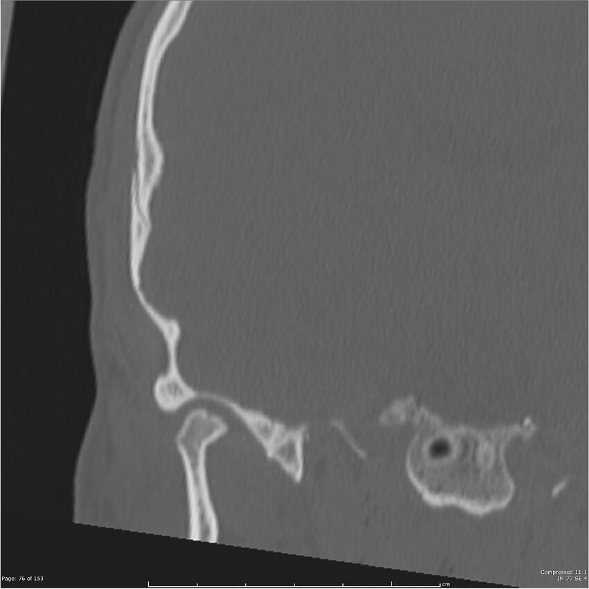 Acute otomastoiditis (Radiopaedia 28276-28512 Coronal PTB bone window reformat 7).jpg