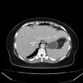 Acute pancreatitis - Balthazar C (Radiopaedia 26569-26714 Axial C+ portal venous phase 23).jpg