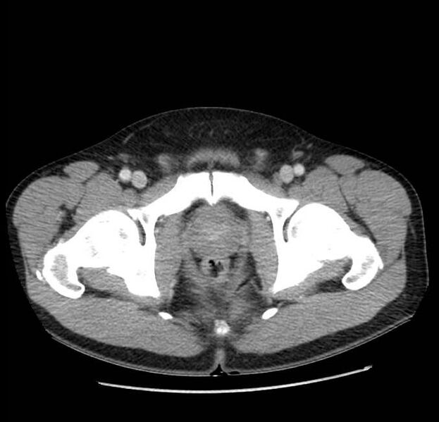 File:Acute pancreatitis - Balthazar E (Radiopaedia 23080-23110 Axial C+ portal venous phase 72).jpg