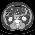 Acute pancreatitis - mild (Radiopaedia 27796-28033 C+ portal venous phase 26).jpg