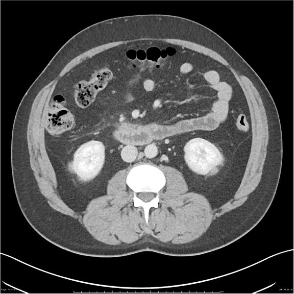 File:Acute pancreatitis - mild (Radiopaedia 27796-28033 C+ portal venous phase 26).jpg