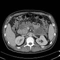 Acute pancreatitis with walled off pancreatic necrosis (Radiopaedia 6438-7797 Axial C+ portal venous phase 8).jpg