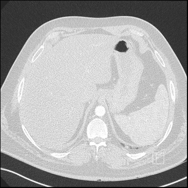 File:Acute pulmonary embolism with pulmonary infarct (Radiopaedia 73062-83768 Axial lung window 29).jpg