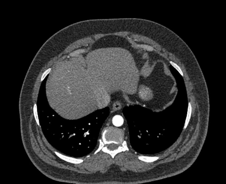 File:Acute pulmonary embolism with pulmonary infarcts (Radiopaedia 77688-89908 Axial C+ CTPA 55).jpg