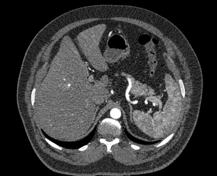 File:Acute pulmonary embolism with pulmonary infarcts (Radiopaedia 77688-89908 Axial C+ CTPA 72).jpg