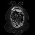 Acute pyelonephritis (Radiopaedia 25657-25837 Coronal renal parenchymal phase 19).jpg