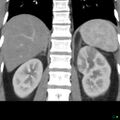 Acute pyelonephritis and emphysematous pyonephrosis (Radiopaedia 27893-28128 Coronal renal cortical phase 13).jpg