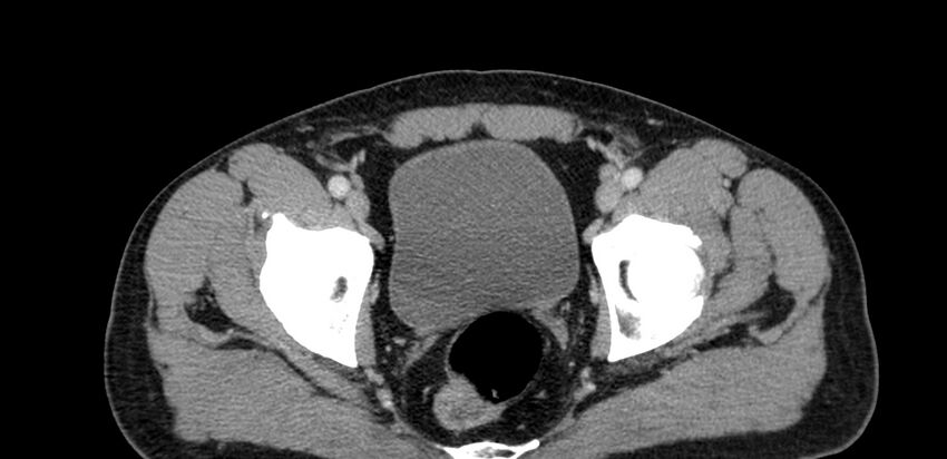 Acute sigmoid colon diverticulitis (Radiopaedia 55507-61976 Axial C+ portal venous phase 112).jpg