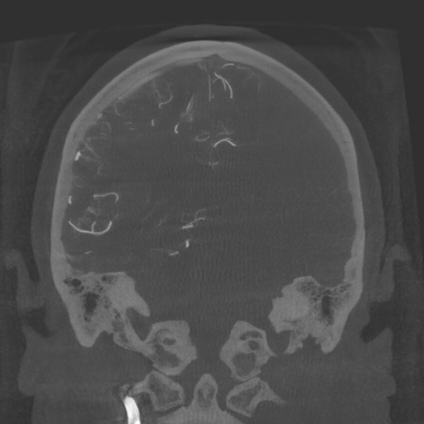 Acute subarachnoid hemorrhage and accessory anterior cerebral artery (Radiopaedia 69231-79010 Coronal arterial - MIP 67).jpg