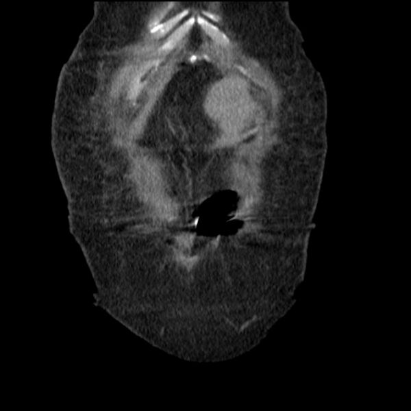 File:Acute tubular necrosis (Radiopaedia 28077-28334 D 13).jpg