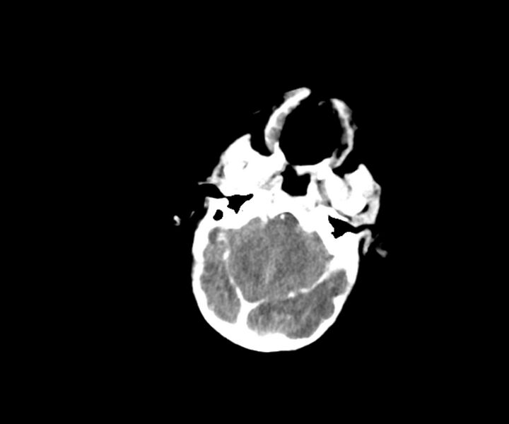 File:Acute ventriculitis (Radiopaedia 57502-64459 Axial +contrast 4).jpg
