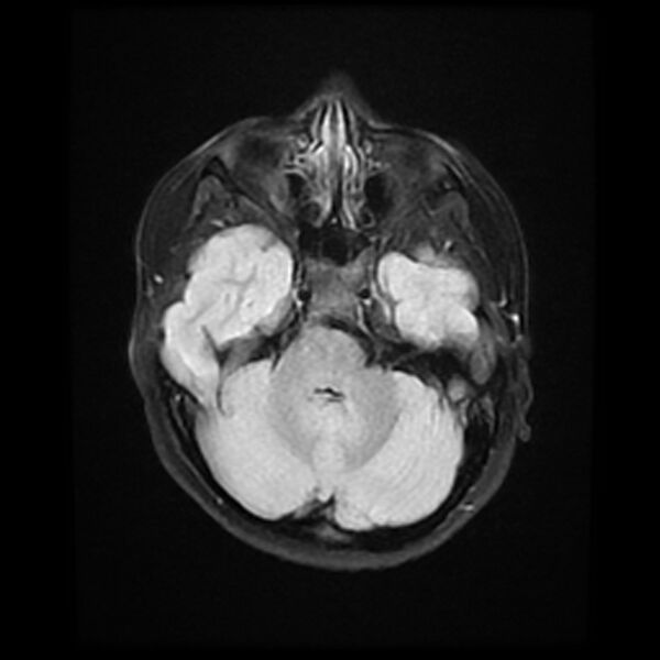 File:Adamantinomatous craniopharyngioma (Radiopaedia 77407-89529 Axial FLAIR 7).jpg