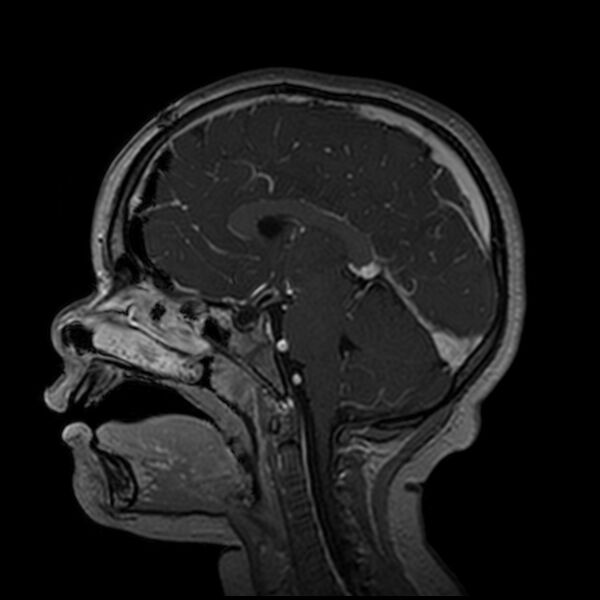 File:Adamantinomatous craniopharyngioma (Radiopaedia 77407-89529 H 58).jpg