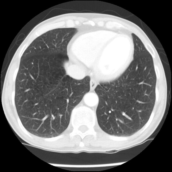 File:Adenocarcinoma of the lung - micropapillary predominant (Radiopaedia 42446-45563 Axial lung window 57).jpg