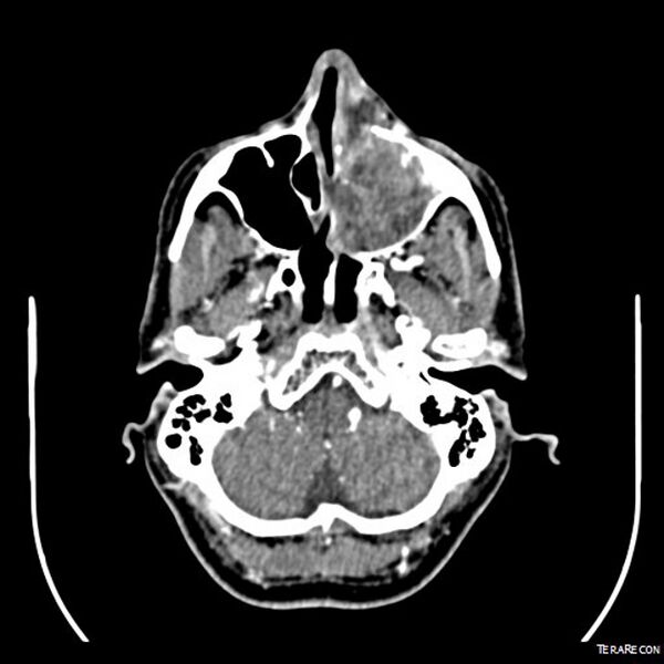 File:Adenoid cystic carcinoma involving paranasal sinus (Radiopaedia 16580-16283 Axial C+ arterial phase 4).jpeg