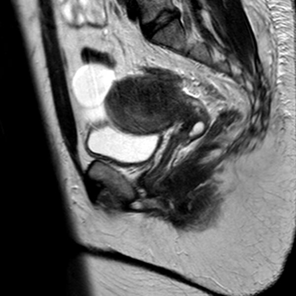 File:Adenomyoma of the uterus (Radiopaedia 9871-10439 Sagittal T2 11).jpg