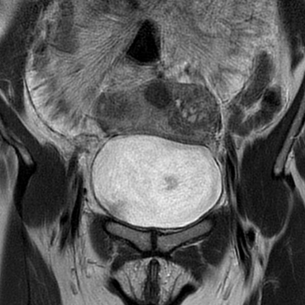 File:Adenomyosis within a septate uterus (Radiopaedia 69963-79981 Coronal T2 5).jpg