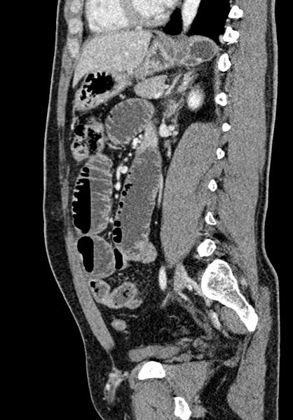 File:Adhesional small bowel obstruction (Radiopaedia 58900-66131 Sagittal C+ portal venous phase 150).jpg