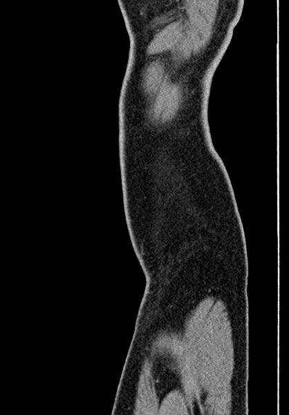 File:Adhesional small bowel obstruction (Radiopaedia 58900-66131 Sagittal C+ portal venous phase 247).jpg