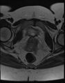 Adnexal multilocular cyst (O-RADS US 3- O-RADS MRI 3) (Radiopaedia 87426-103754 Axial T2 20).jpg