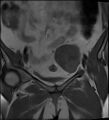 Adnexal multilocular cyst (O-RADS US 3- O-RADS MRI 3) (Radiopaedia 87426-103754 Coronal 11).jpg