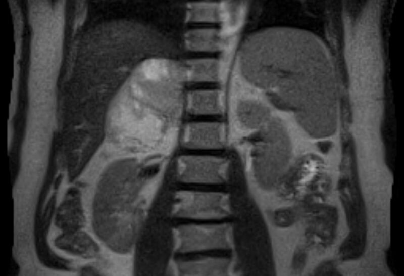 File:Adrenal myelolipoma (Radiopaedia 65240-74254 Coronal T2 12).jpg