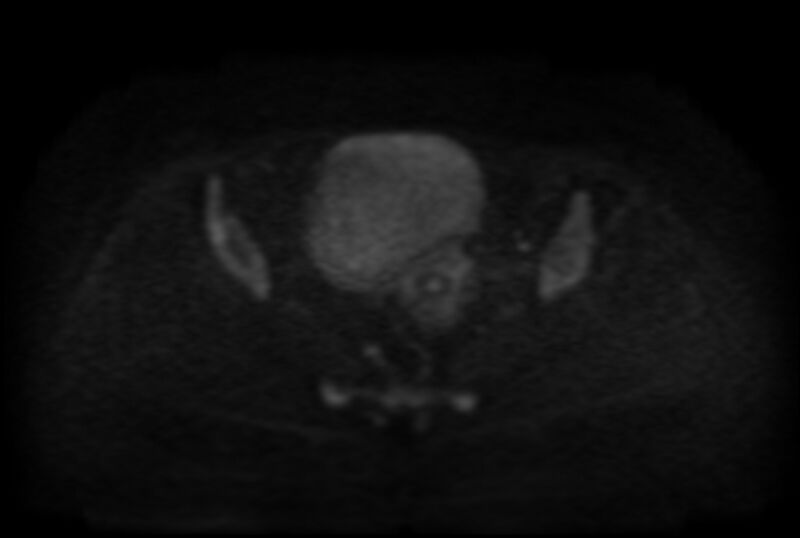 File:Adult granulosa cell tumor of the ovary (Radiopaedia 71581-81950 Axial DWI 14).jpg