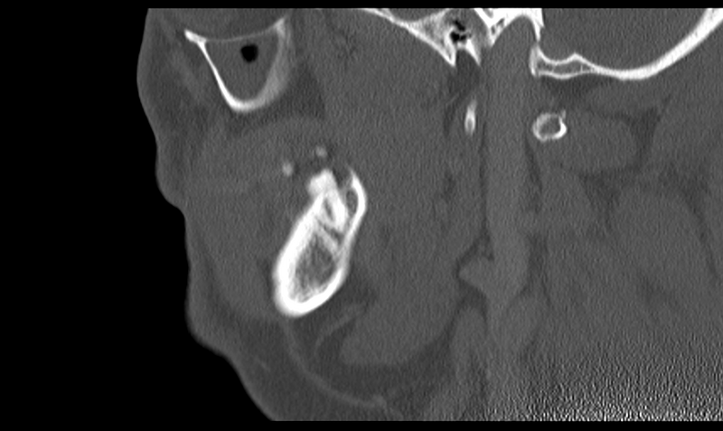 File:Ameloblastoma (Radiopaedia 33677-34806 Sagittal bone window 44).png