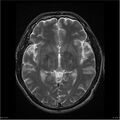 Amnestic syndrome secondary to hypoxic brain injury (Radiopaedia 24743-25004 T2 10).jpg
