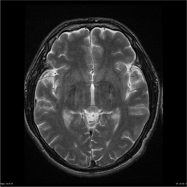 File:Amnestic syndrome secondary to hypoxic brain injury (Radiopaedia 24743-25004 T2 10).jpg
