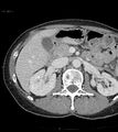 Ampulla of Vater metastasis (Radiopaedia 27820-28065 A 5).jpg