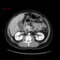Ampullary carcinoma (Radiopaedia 56396-63056 B 32).jpg