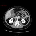 Ampullary carcinoma (Radiopaedia 56396-63056 B 38).jpg