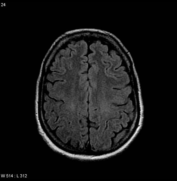 File:Amyotrophic lateral sclerosis (Radiopaedia 4719-6744 Axial FLAIR 7).jpg