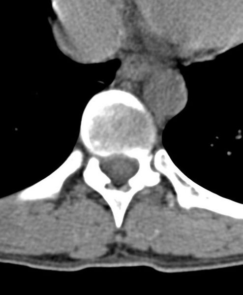 File:Aneurysmal bone cyst T11 (Radiopaedia 29294-29721 Axial non-contrast 28).jpg