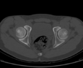 Aneurysmal bone cyst of ischium (Radiopaedia 25957-26094 Axial bone window 56).png