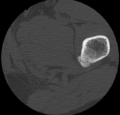 Aneurysmal bone cyst of ischium (Radiopaedia 25957-26094 B 59).png