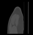 Aneurysmal bone cyst of ischium (Radiopaedia 25957-26094 Sagittal bone window 1).png
