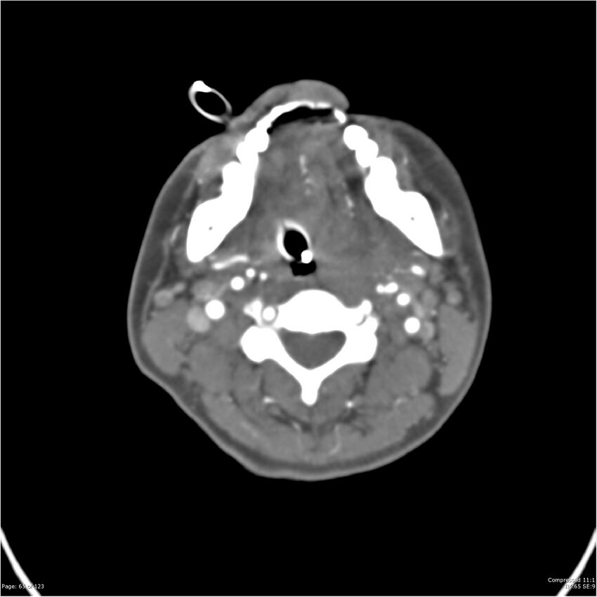 Aneurysmal subarachnoid hemorrhage and Moya Moya disease (Radiopaedia 34306-35593 Axial CT COW 65).jpg
