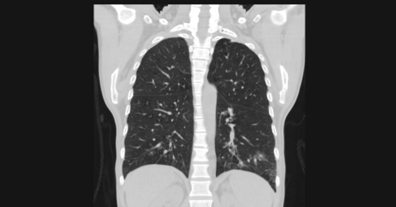 File:Angioinvasive aspergellosis (Radiopaedia 66995-76315 Coronal lung window 43).jpg
