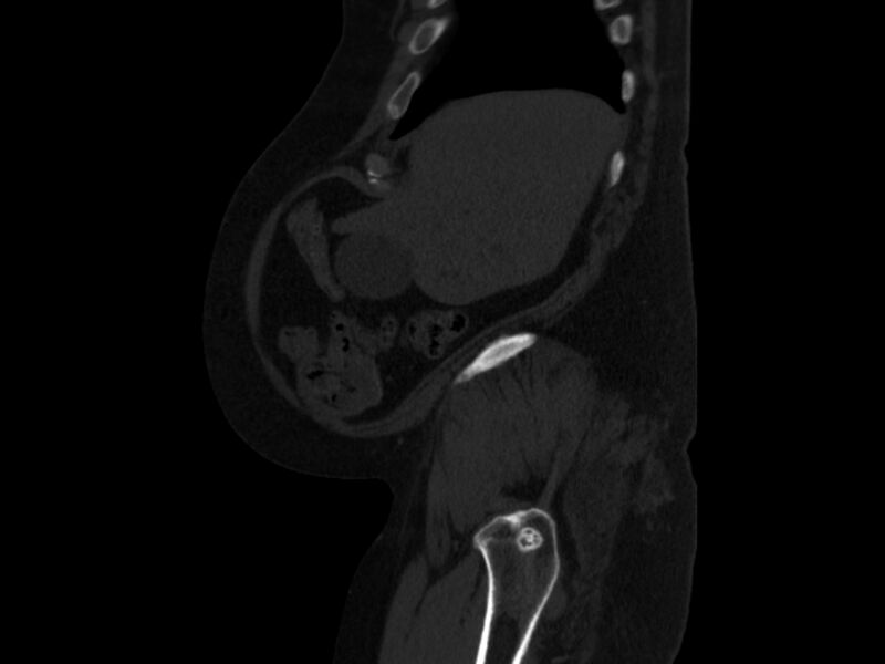 File:Ankylosing spondylitis (Radiopaedia 44609-48357 Sagittal bone window 6).jpg