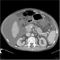 Annular pancreas and cirrhosis (Radiopaedia 24561-24843 A 8).jpg