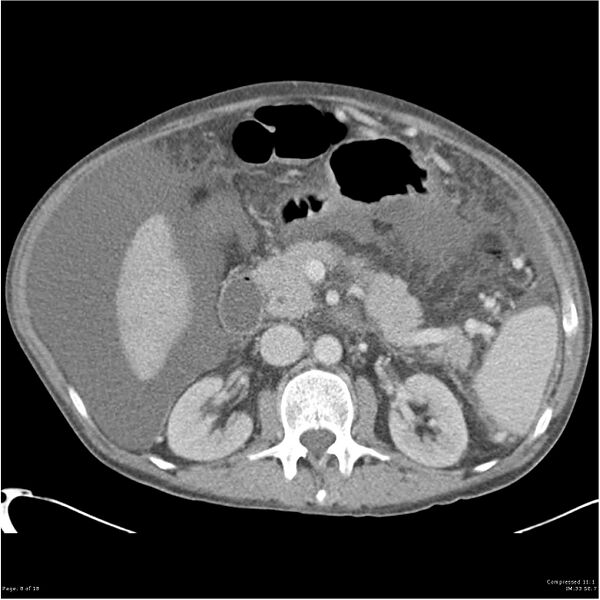 File:Annular pancreas and cirrhosis (Radiopaedia 24561-24843 A 8).jpg