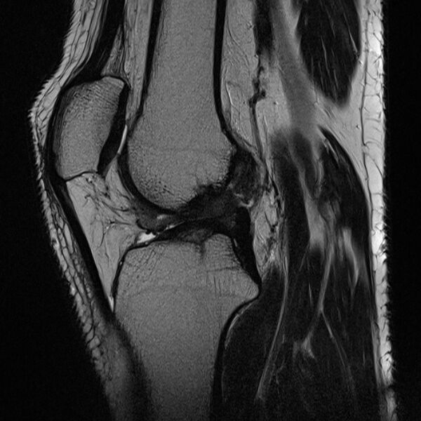 File:Anterior cruciate ligament tear - ramp lesion (Radiopaedia 71883-82322 Sagittal T2 13).jpg