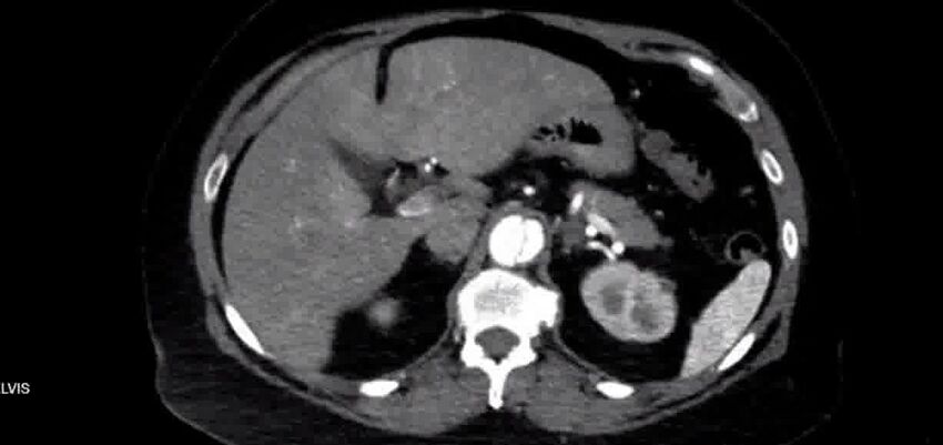 Aortic Dissection (Radiopaedia 85272-100847 A 48).jpg
