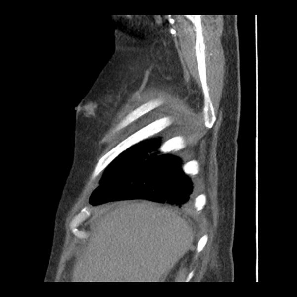 File:Aortic arch graft infection (FDG PET-CT) (Radiopaedia 71975-82437 C 8).jpg