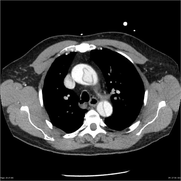 File:Aortic dissection- Stanford A (Radiopaedia 37759-39664 A 17).jpg
