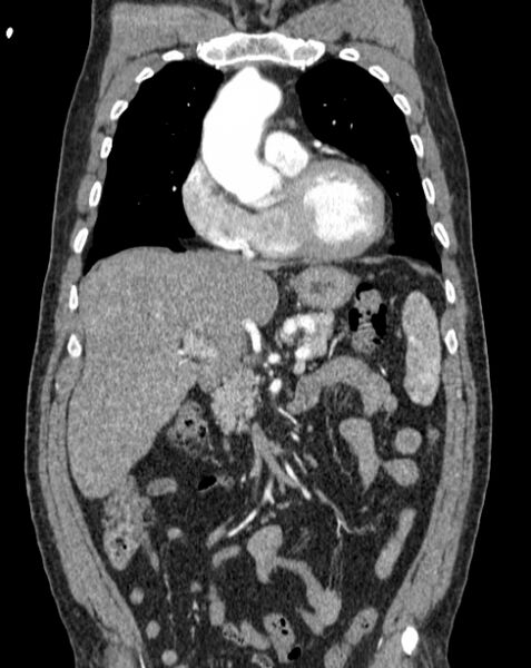 File:Aortic dissection (Radiopaedia 44411-48061 A 9).jpg