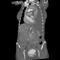 Aortic dissection (Radiopaedia 68763-78691 B 12).jpeg