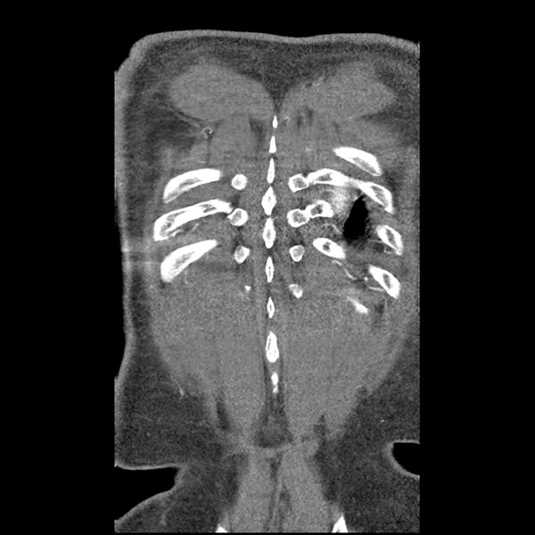 File:Aortic dissection - DeBakey Type I-Stanford A (Radiopaedia 79863-93115 B 37).jpg